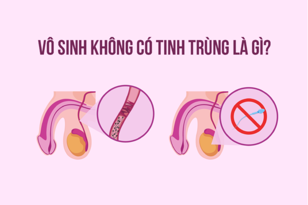 Vô sinh không có tinh trùng – Nguyên nhân và cách điều trị – Trung tâm IVF Bệnh viện Quốc tế Sản Nhi Hải Phòng.