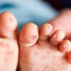 Bệnh tay-chân-miệng: Tưởng đơn giản nhưng chớ nên chủ quan