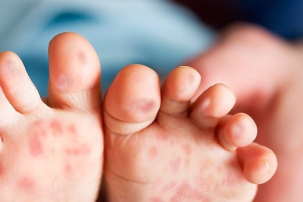 Bệnh tay-chân-miệng: Tưởng đơn giản nhưng chớ nên chủ quan