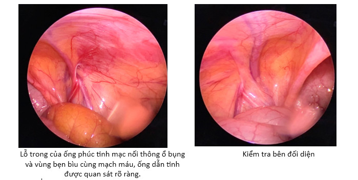 bệnh lý còn ống phúc tinh mạc