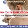 Bệnh thuỷ đậu vào mùa, ba mẹ đừng chủ quan