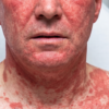 VANCOMYCIN VÀ HỘI CHỨNG ĐỎ NGƯỜI