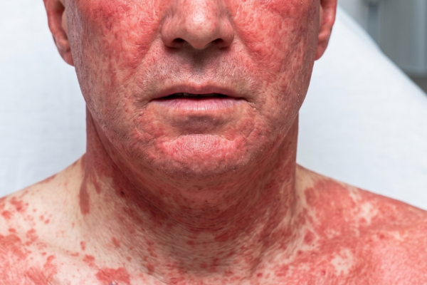 VANCOMYCIN VÀ HỘI CHỨNG ĐỎ NGƯỜI
