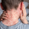 LỰA CHỌN KHÁNG SINH TRONG ĐIỀU TRỊ SỞI CÓ BIẾN CHỨNG